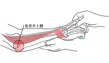 什么是肱骨外上髁炎？多發(fā)于那些人群？